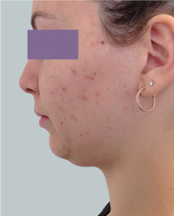 cs1_liposuction_face_before-img