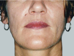 cs1_liposuction_Face_after-img