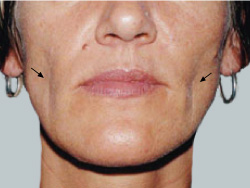 cs1_liposuction_face_before-img