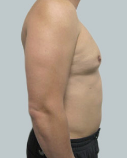 cs1_liposuction_face_before-img