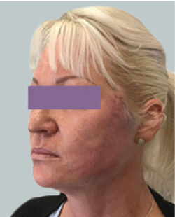 cs1_liposuction_Face_after-img