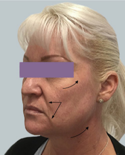 cs1_liposuction_face_before-img