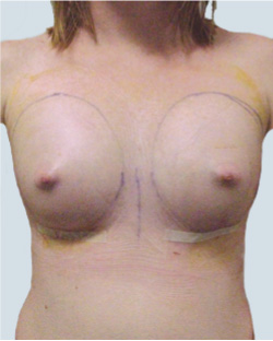 cs1_liposuction_Face_after-img