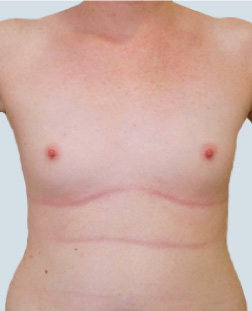 cs1_liposuction_face_before-img