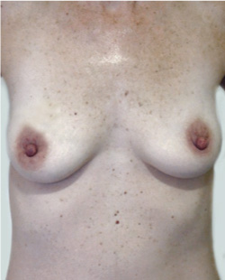 cs1_liposuction_face_before-img