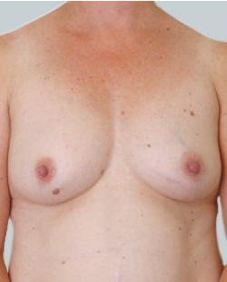 cs1_liposuction_face_before-img