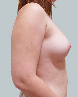 cs1_liposuction_Face_after-img