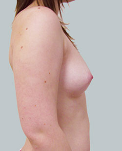 cs1_liposuction_face_before-img