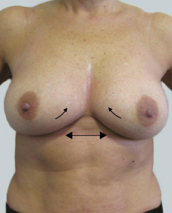 cs1_liposuction_Face_after-img