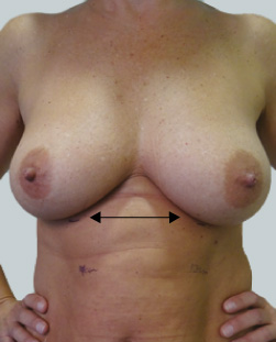 cs1_liposuction_face_before-img