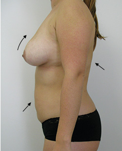 cs1_liposuction_Face_after-img