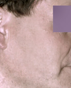 cs1_liposuction_Face_after-img