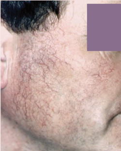 cs1_liposuction_face_before-img