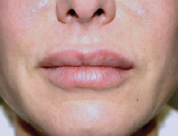 cs1_liposuction_Face_after-img