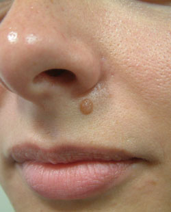 cs1_liposuction_face_before-img