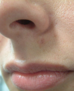 cs1_liposuction_Face_after-img