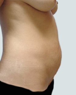 cs1_liposuction_face_before-img