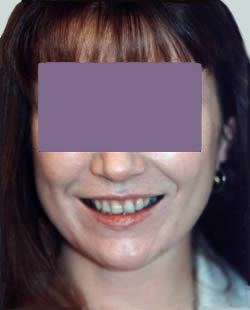 cs1_liposuction_Face_after-img