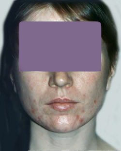 cs1_liposuction_face_before-img