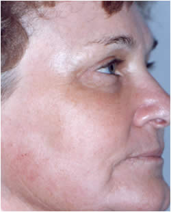 cs1_liposuction_Face_after-img