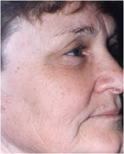 cs1_liposuction_face_before-img