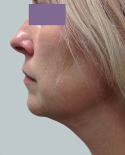 cs1_liposuction_Face_after-img