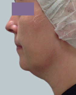 cs1_liposuction_face_before-img