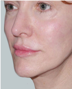 cs1_liposuction_Face_after-img