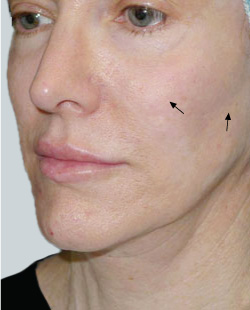 cs1_liposuction_face_before-img