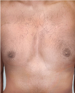 cs1_liposuction_Face_after-img