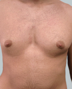 cs1_liposuction_face_before-img