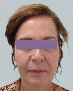 cs1_liposuction_Face_after-img