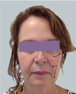 cs1_liposuction_face_before-img