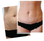Abdominoplasty Scar