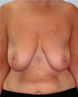 cs1_liposuction_face_before-img