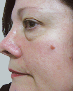 mole removal cream before and after