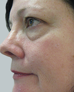 cs1_liposuction_Face_after-img