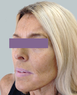 cs1_liposuction_Face_after-img