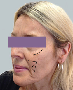 cs1_liposuction_face_before-img