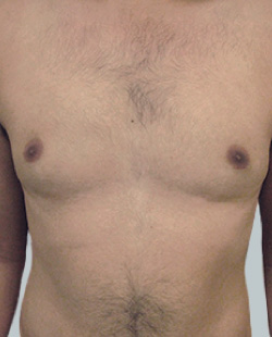 cs1_liposuction_Face_after-img