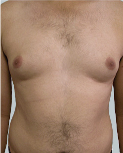 cs1_liposuction_face_before-img