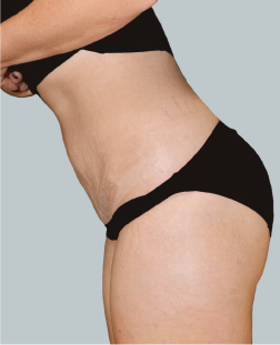 cs1_liposuction_Face_after-img