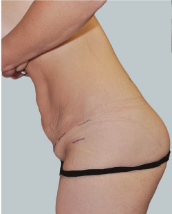 cs1_liposuction_face_before-img