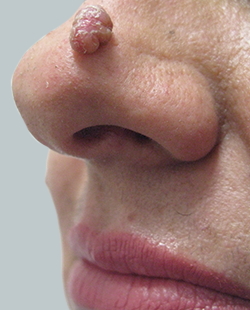 cs1_liposuction_face_before-img