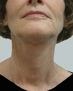 cs1_liposuction_Face_after-img