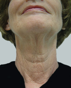 cs1_liposuction_face_before-img