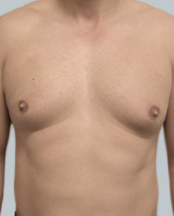 cs1_liposuction_face_before-img