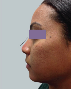 cs1_liposuction_Face_after-img