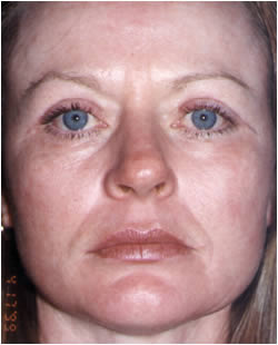 cs1_liposuction_Face_after-img