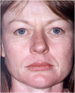 cs1_liposuction_face_before-img